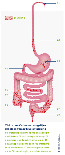 Ziekte van Crohn